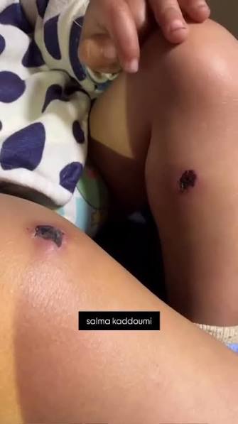 تعذيب الرضيع الفلسطيني جواد أبو نصار في قطاع غزة. 2 images 2